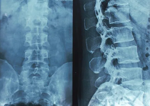 X-ray of the spine