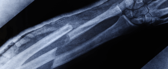Broken bone in an arm